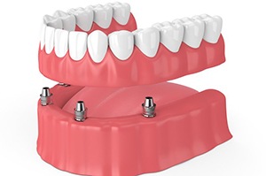 Diagram of a model holding dental implants in Plano