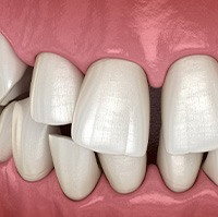 Illustration of gapped teeth