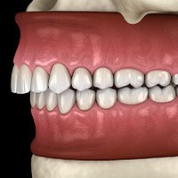 Illustration of an overbite