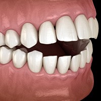 Illustration of an open bite