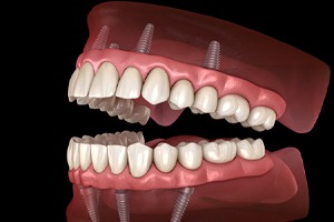 All-On-4 implants in Plano