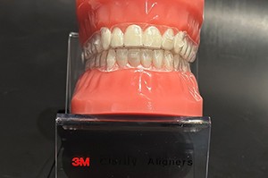 Model wearing 3M clear aligners