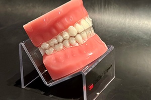 Tooth model with 3M clear aligners viewed from the side