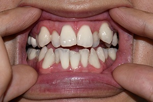 Close-up of person’s crowded, overlapping teeth