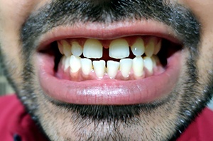 Man’s smile with noticeable gaps between the teeth
