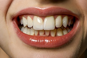 Close-up of woman’s smile with a significant overbite