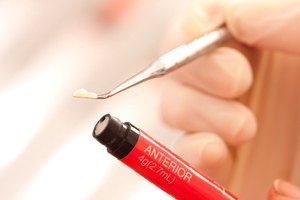 A dental professional using a small dental tool to remove composite resin from a tube in preparation for placement