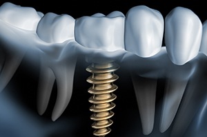 X-ray of a person with dental implants in Plano