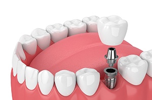 dental implant being placed in the lower jaw