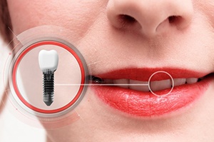 close-up of a woman smiling with a dental implant