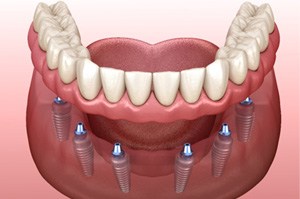 A 3D illustration of implant dentures