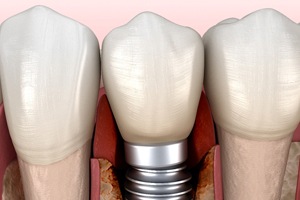 Illustration of bone loss around failed dental implant in Plano, TX
