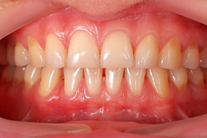 A person's gums and other soft tissues