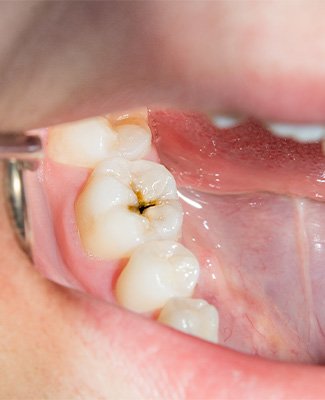 Closeup of a cavity in someone’s lower tooth