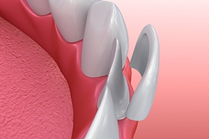 Illustration of veneer being placed on lower, front tooth