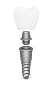 Dental implant