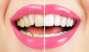 Custom-fitted whitening trays ensure accurate application of gel.