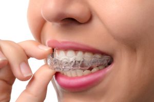 Why should I get Invisalign in Plano?