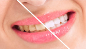 Before and after teeth whitening