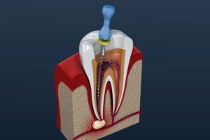 Model of root canal treating infected tooth