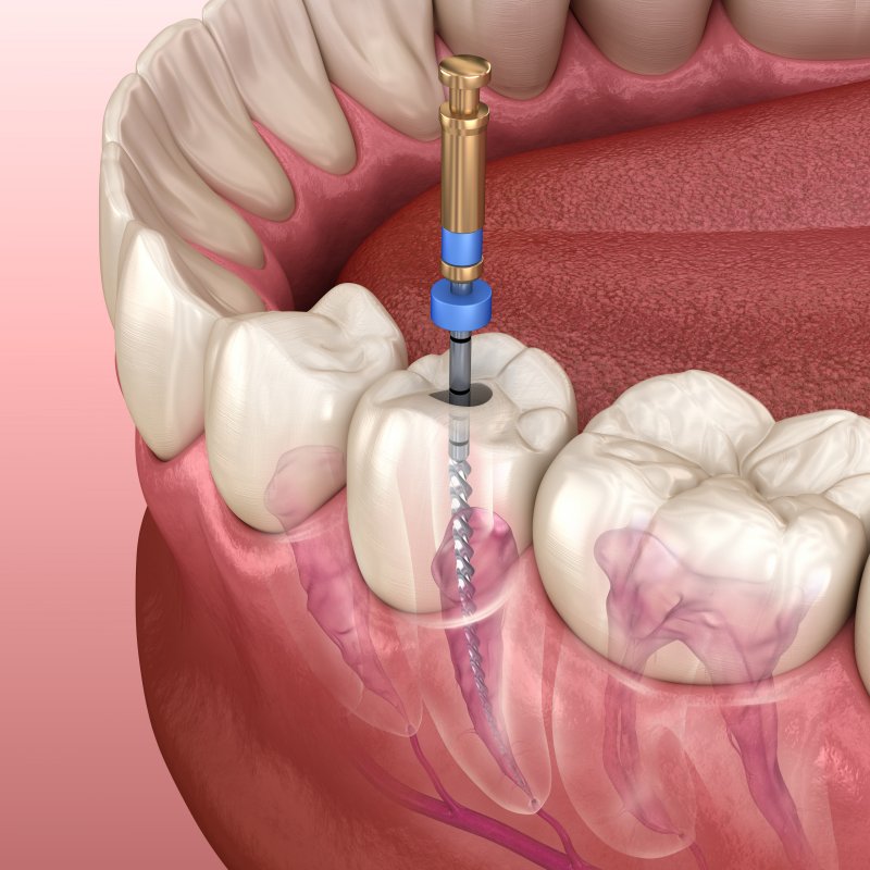 illustration showing process of root canal in Plano