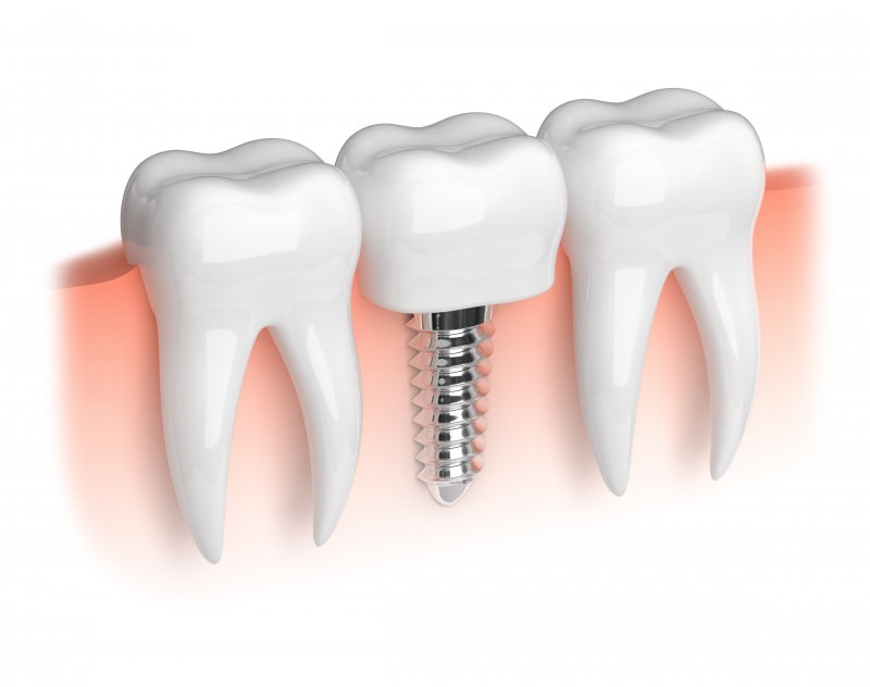 Model of white teeth and dental implant