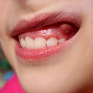 Person smiling revealing a large bump on their upper gums.